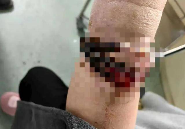 登1信用盘代理
_女子手镯10年没摘竟“长”进肉里登1信用盘代理
!医生:再晚点就保不住了